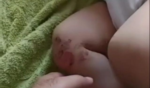 Piknik Alanında Köz Faciası: Küçük Göktuğ Yandı